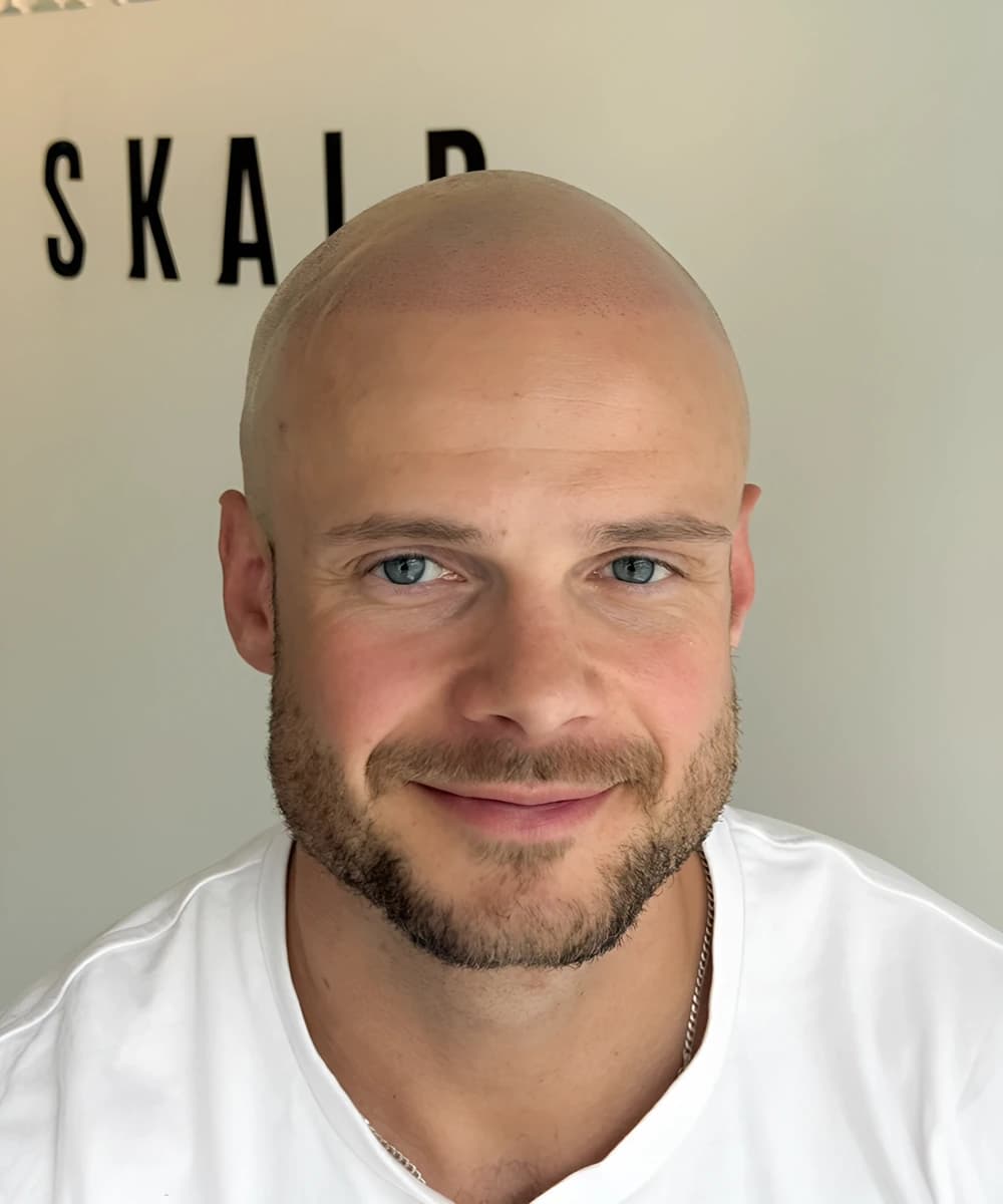 Hodebunn med ferdig skalpmikropigmentering
