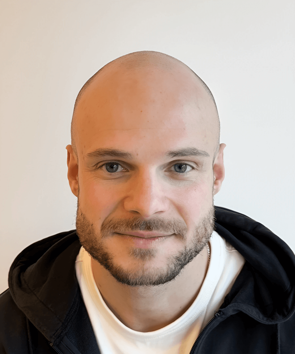 Hodebunn før skalpmikropigmentering